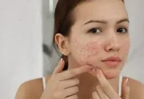 Acne treatment
