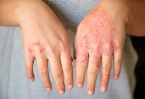 Eczema