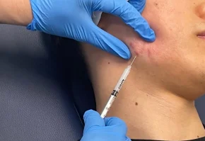 Intralesional injections