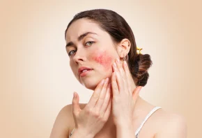 Rosacea