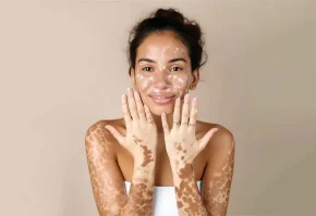 Vitiligo treatment