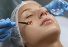 chemical-peels