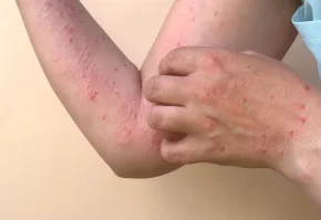 skin infection